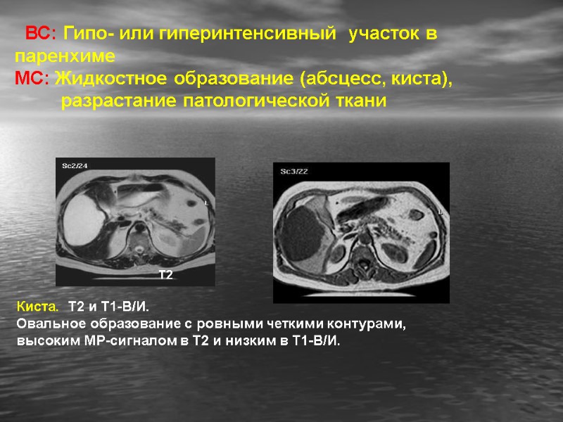 Киста.  Т2 и Т1-В/И.  Овальное образование с ровными четкими контурами, высоким МР-сигналом